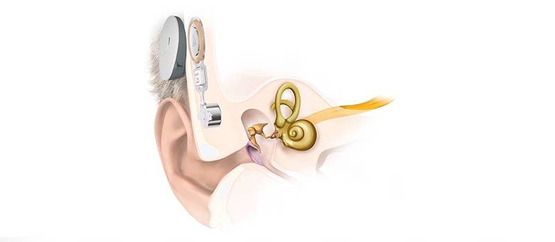 Bonebridge bone conduction implantaat